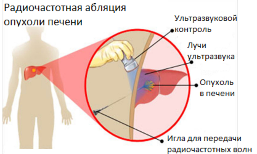 абляция