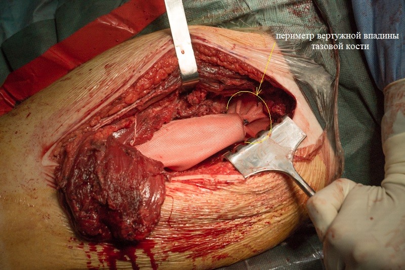 endo29