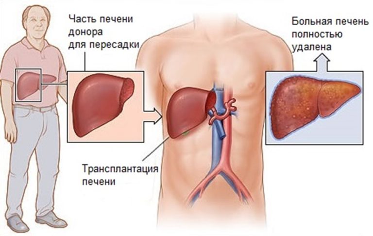 Пересадка печени