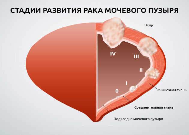 Opuhol-mochevogo-puzyrya