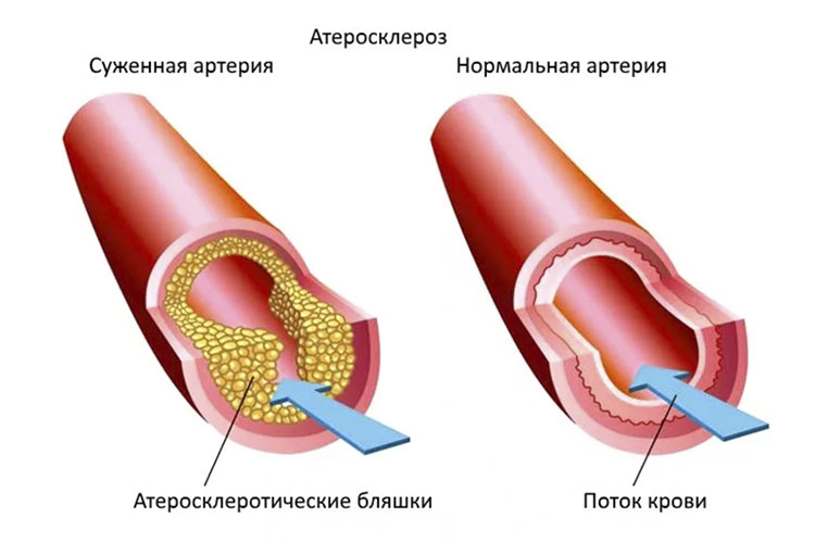 атеросклероз1