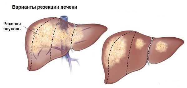 pechen1