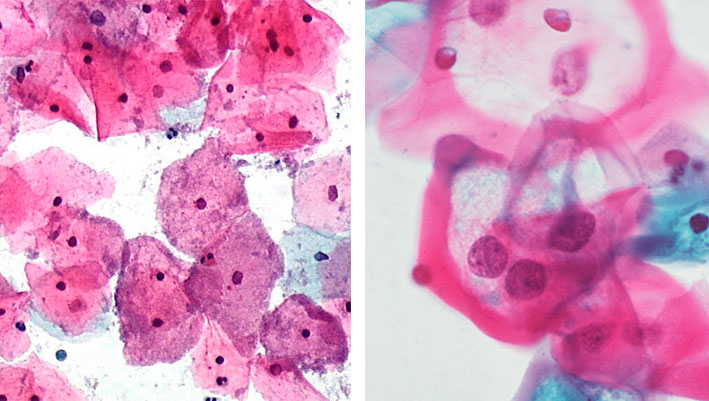 bacterial-vaginosi