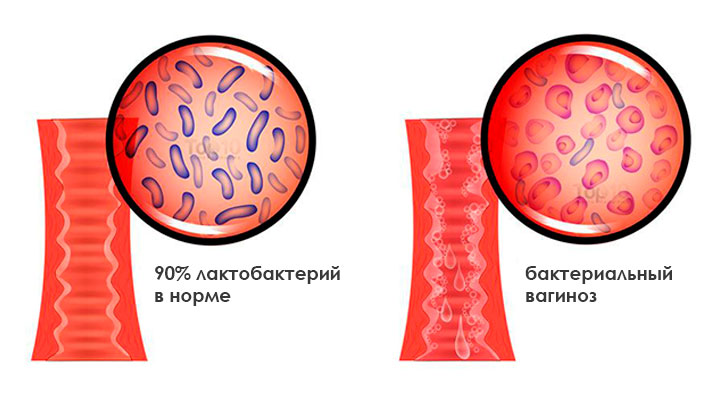 bacterial-vaginosis-diagram