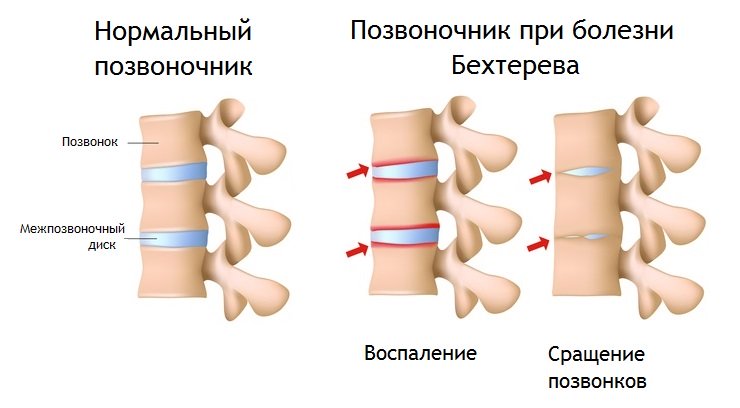 бехтерева1