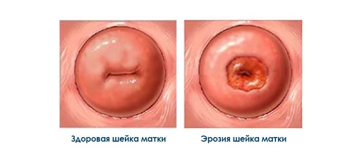 eroziya