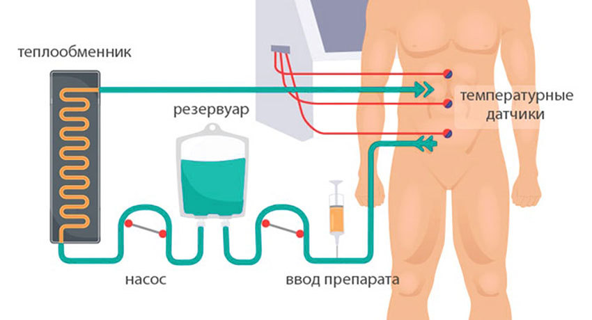 Схема проведения HIPEC