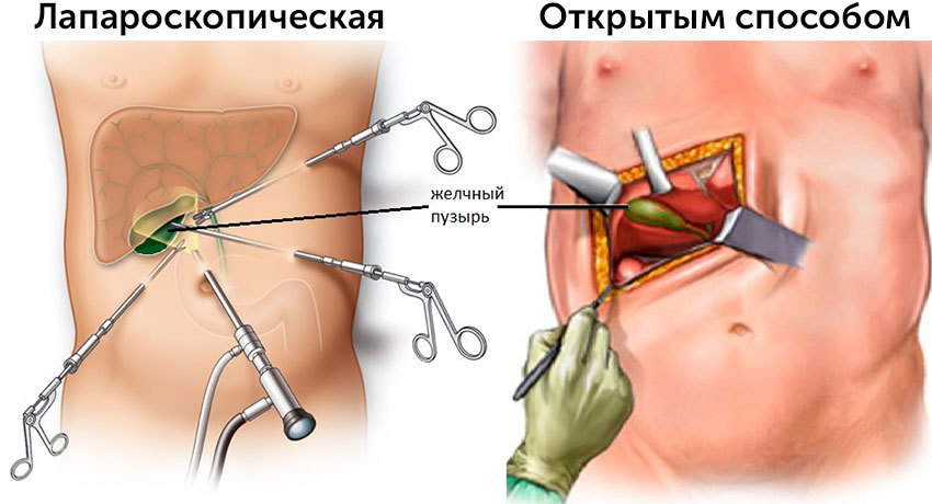 Виды холецистэктомии