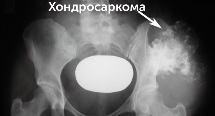 Хондросаркома на рентгеновском снимке