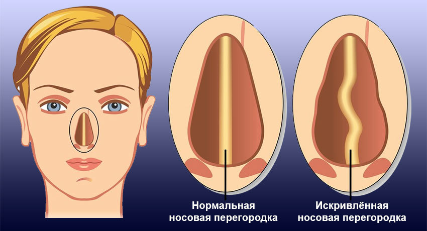 Сравнение нормальной и искривлённой перегородки