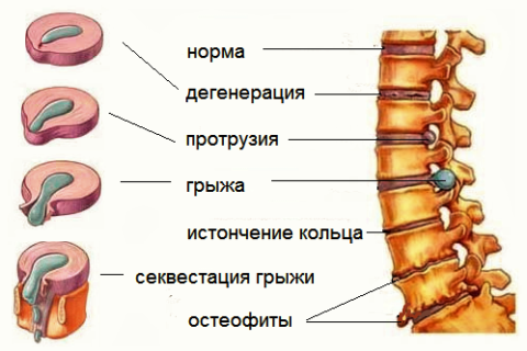 грыжа3