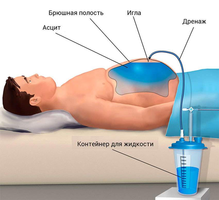 Лапароцентез 