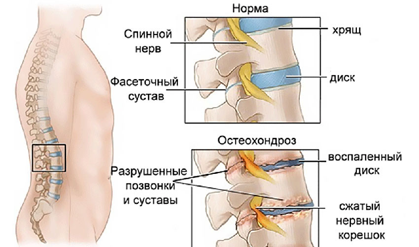 Пояснично-крестцовый остеохондроз